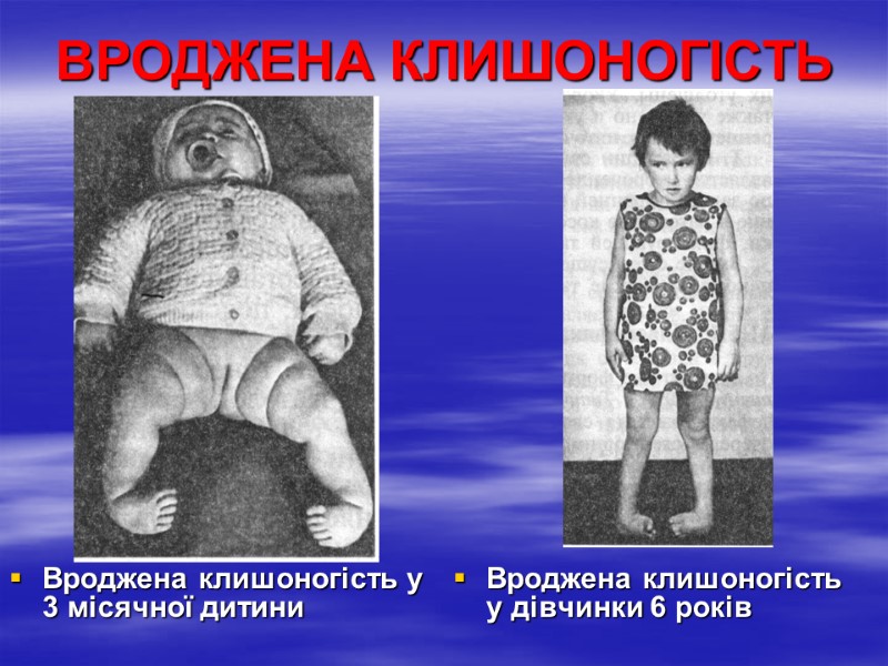 Вроджена клишоногість у 3 місячної дитини Вроджена клишоногість у дівчинки 6 років ВРОДЖЕНА КЛИШОНОГІСТЬ